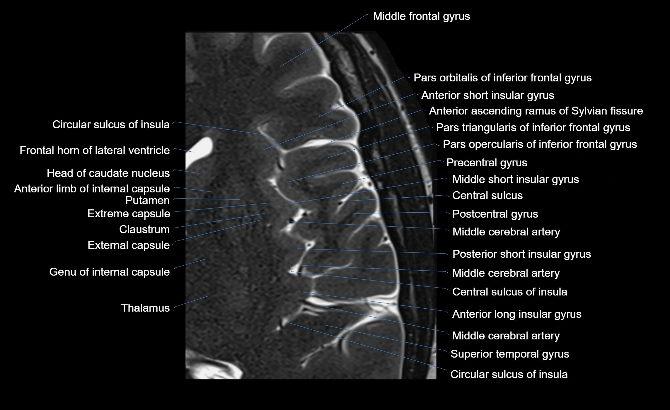 Brain insula axial  anatomy 3T MRI image-img-00001-00013.webp